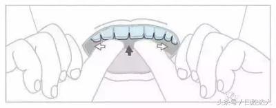 隐形牙套佩戴注意事项,替牙期隐形牙套佩戴管理