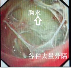 胸水抽了为什么还呼吸困难,胸水抽不出来了怎么回事