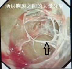 胸水为什么会抽不到,胸水抽了为什么还呼吸困难