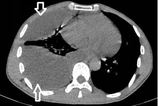 胸水为什么会抽不到,胸水抽了为什么还呼吸困难