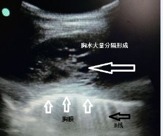 胸水抽了为什么还呼吸困难,胸水抽不出来了怎么回事