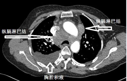 胸水抽了为什么还呼吸困难,胸水抽不出来了怎么回事