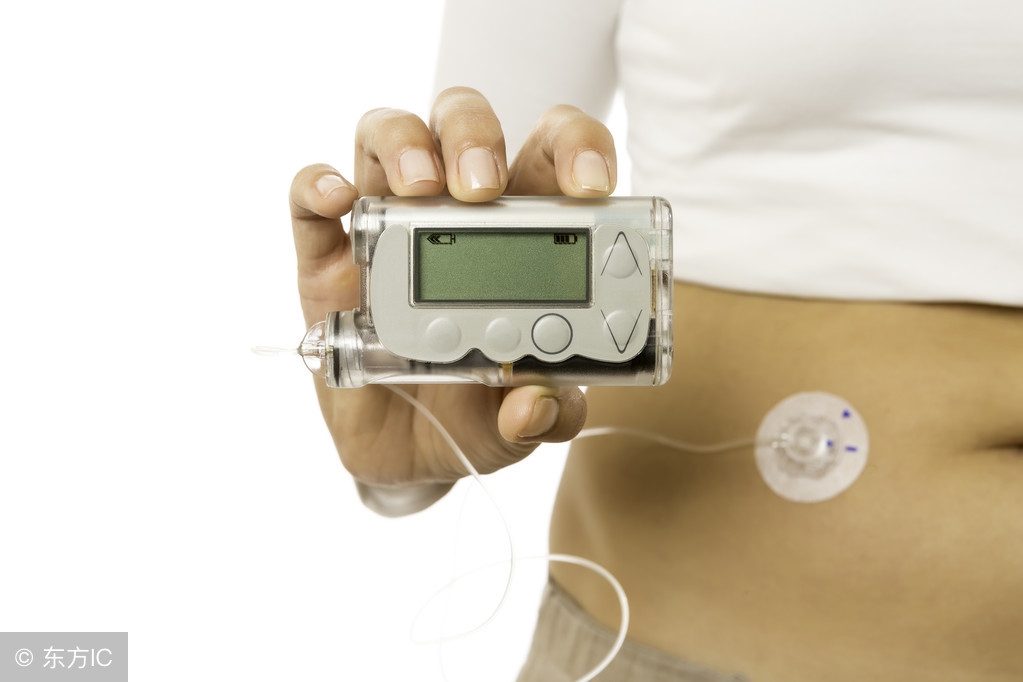 1型糖尿病最新胰岛素泵临床治疗,糖尿病用的胰岛素泵使用方法