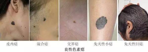 胎记有黑痣去哪个医院,胎记黑痣凸起发痒
