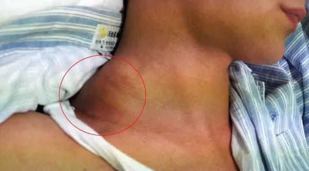 胎记有黑痣去哪个医院,胎记黑痣凸起发痒