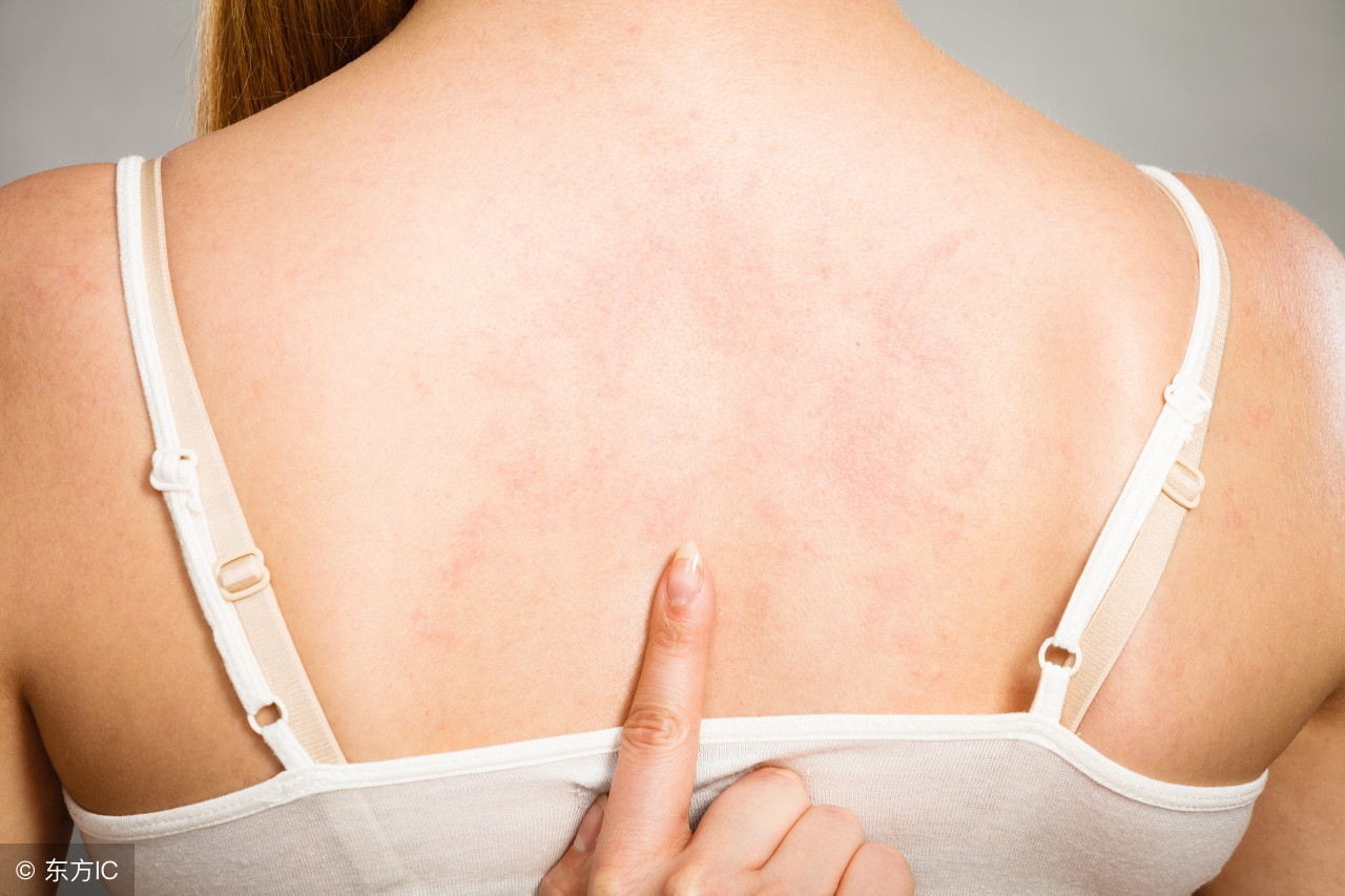 湿疹脱皮是怎么回事,湿疹脱皮结痂用什么药