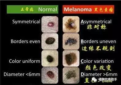 正常的黑痣和黑色素瘤有什么区别,痣和黑色素瘤区别特别小
