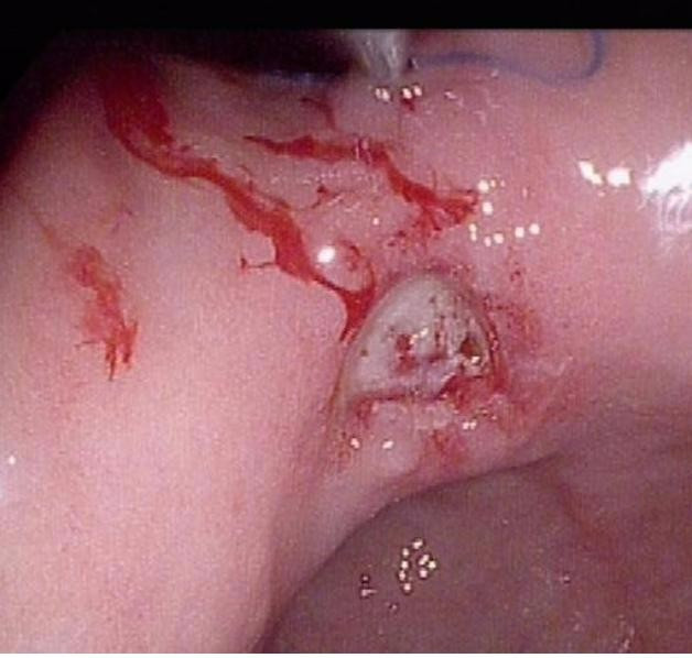 胃溃疡介绍视频,胃溃疡解析图