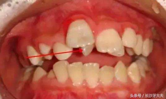 孩子门牙多生牙拔了之后牙缝很大,8岁男童多生牙门牙缝隙大