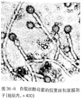看懂痰涂片的真菌结果就这么简单！