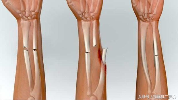 病人碎裂的骨头，医生是怎么修复的？
