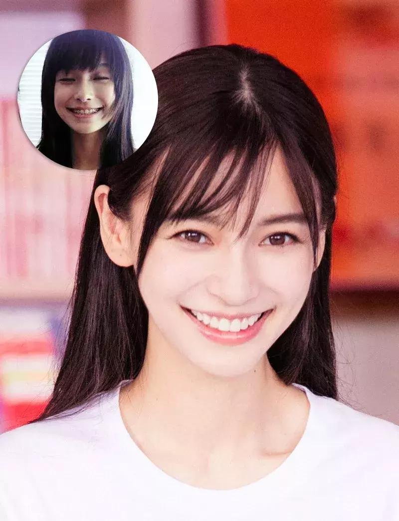 整牙后颜值明显变化的明星,明星真的会因为整牙而变漂亮了吗