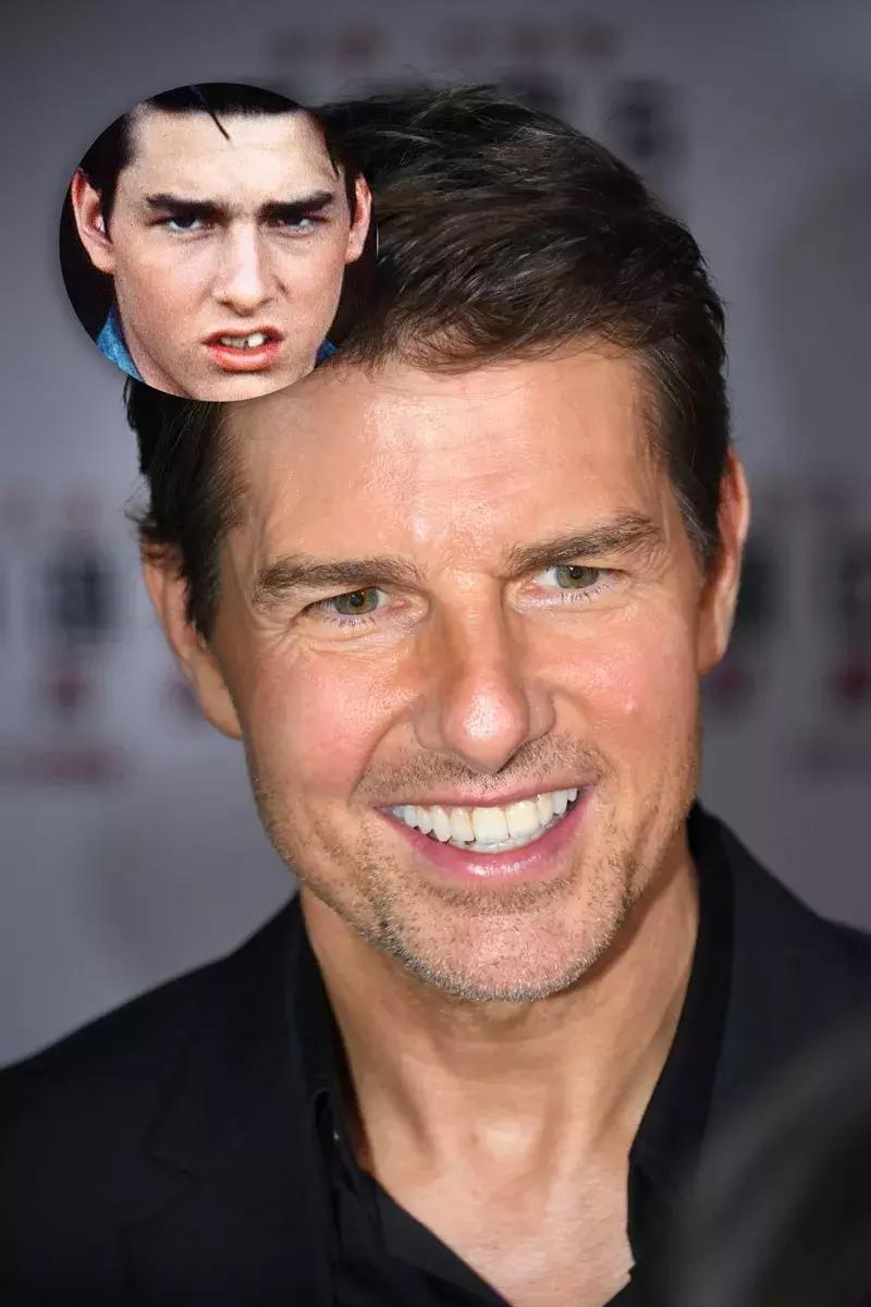 还在犹豫是否整牙，明星们默默变美都在靠它，你想知道的这篇都有