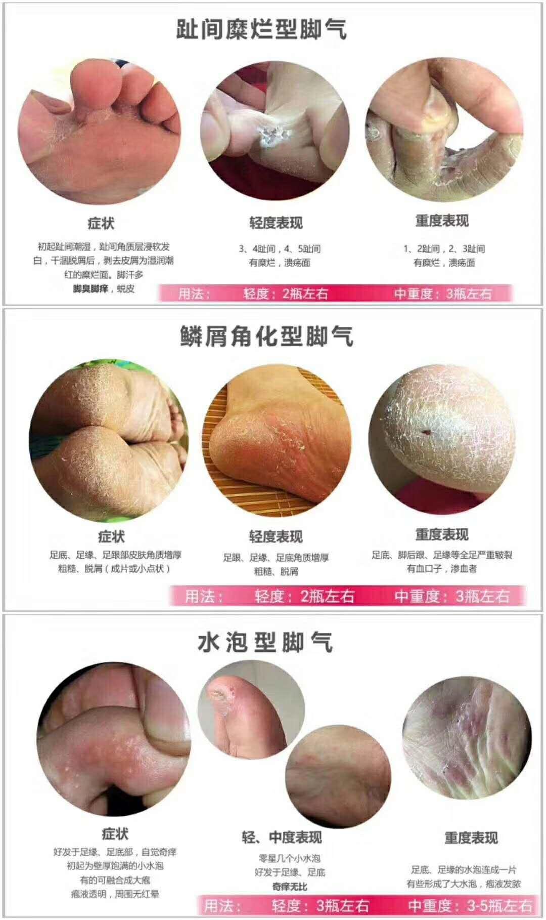 脚气治疗要吃什么药,脚气用什么药膏涂抹好得快