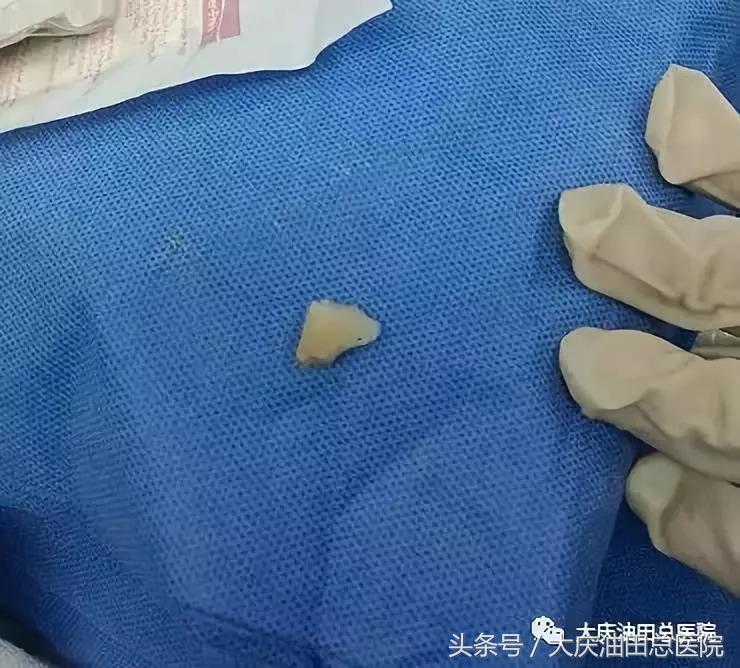 异物呛入气管的急救方法有哪三种,成人大蒜呛到鼻腔小妙招