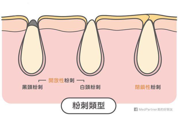 黑头贴吸出来的是粉刺还是黑头,去黑头闭口粉刺用黑头贴可以吗