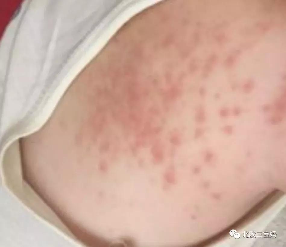 儿童急疹科普,宝宝湿疹和热疹的正确护理方法