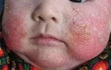 宝宝湿疹终于好了,宝宝湿疹治愈经历