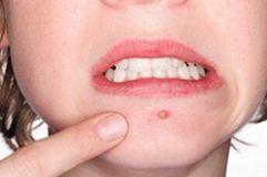 闭口痘痘涂什么药膏医生推荐,闭口粉刺痘痘痘印用什么护肤品