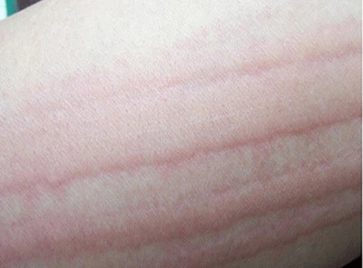 急性荨麻疹痒可以挠吗,荨麻疹挠痒后皮肤上出现红斑