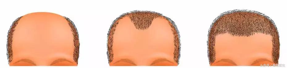 开始秃头有得治吗,年纪轻轻秃头是因为什么