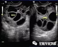 做试管婴儿促排卵时，B超能看到几个卵泡，促排卵就能取出几个卵吗？