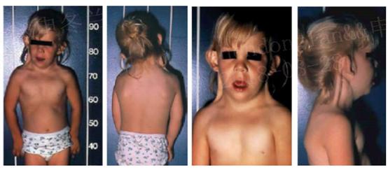 怎么规避turner综合征,turner综合征吃什么