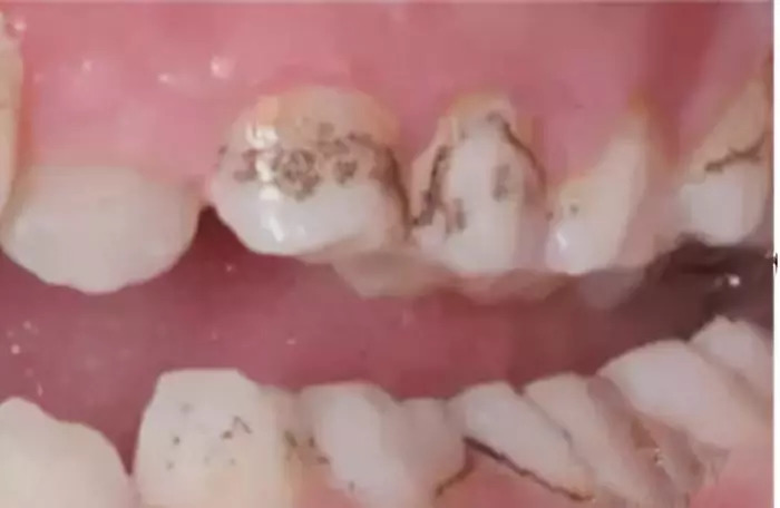 几岁的儿童牙齿就烂了是什么原因,宝宝牙齿烂光了只剩下牙根怎么办
