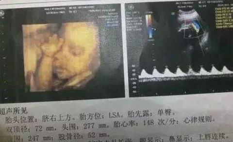产检4维彩超需要注意什么,4维彩超能做出的畸形有哪些