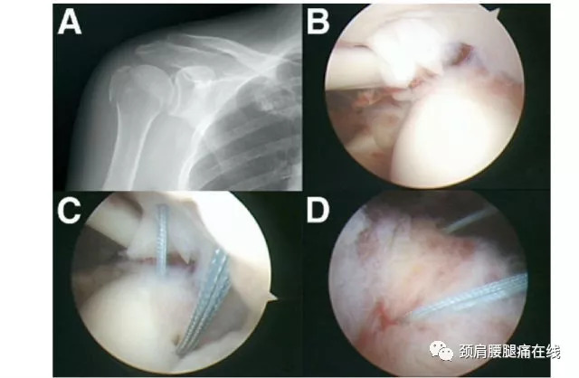 膝盖做关节镜手术多久能恢复,痛风关节镜手术多久可以恢复