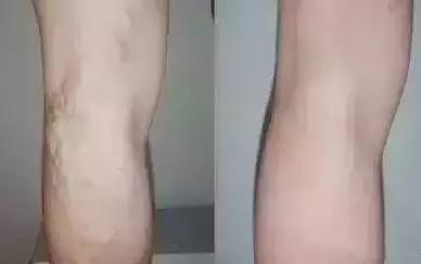 警惕肝脏的5个征兆,肝青筋