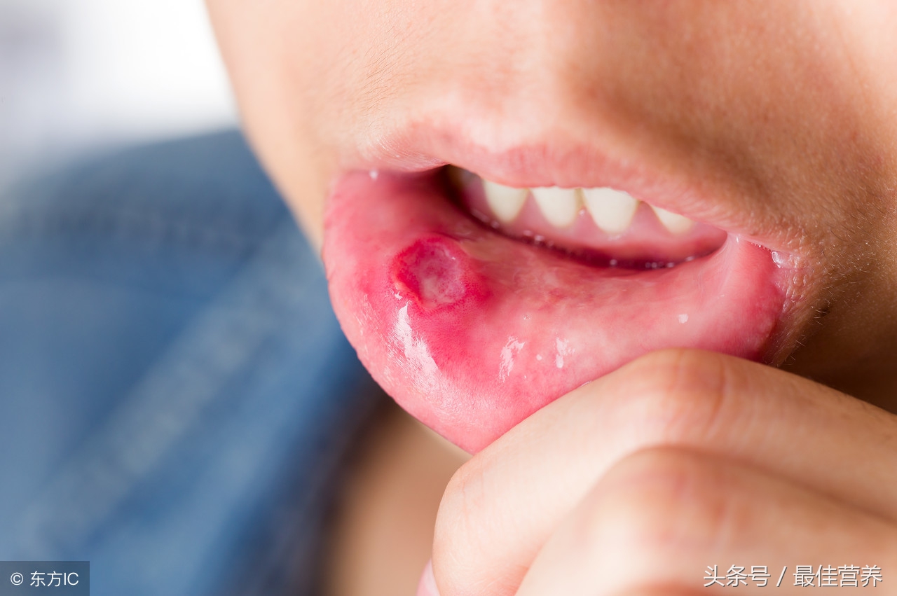 消除口干口臭口苦,告别口臭的最快方法