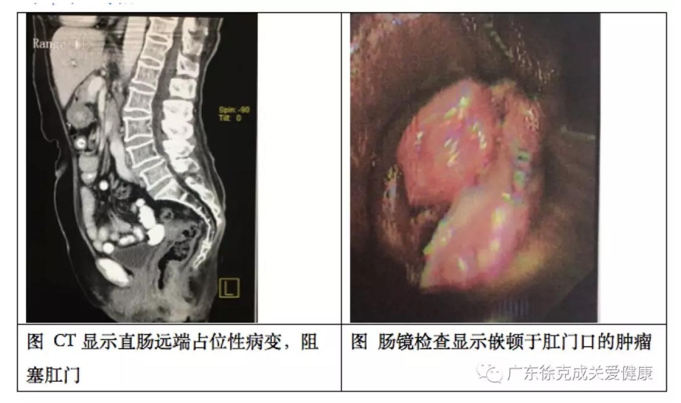 徐克成抗癌4句话,徐克成癌症视频全集