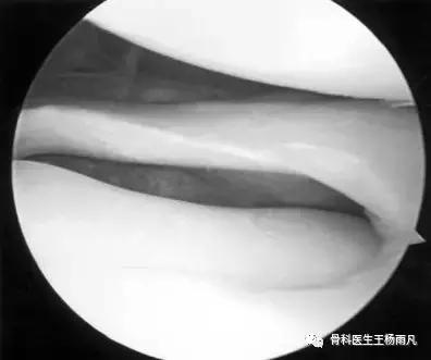 关于半月板的正确说法,半月板前世是什么