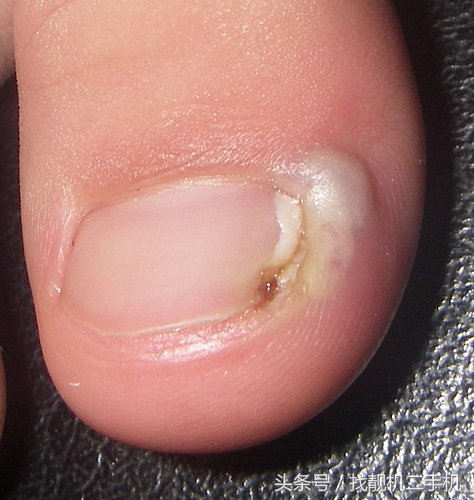 脚指甲长到肉里面，到底要怎么办？