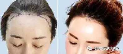 寰瘺鍙戠Щ妞嶆湳,鏉忔灄姣涘彂绉绘鎵嬫湳