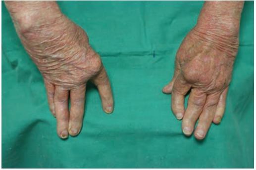 世界银屑病日银屑病关节炎,银屑病关节炎是银屑病后期吗