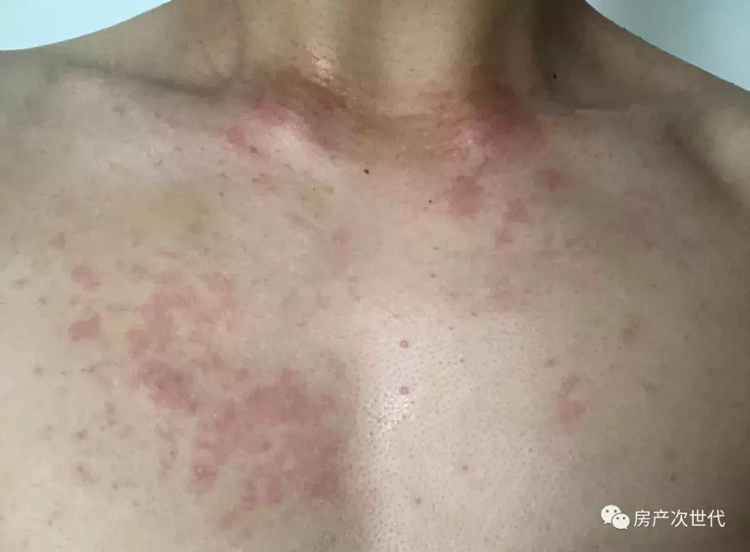 头昏、失眠、全身红疹、不能维权，我住的可是最贵的自如寓！