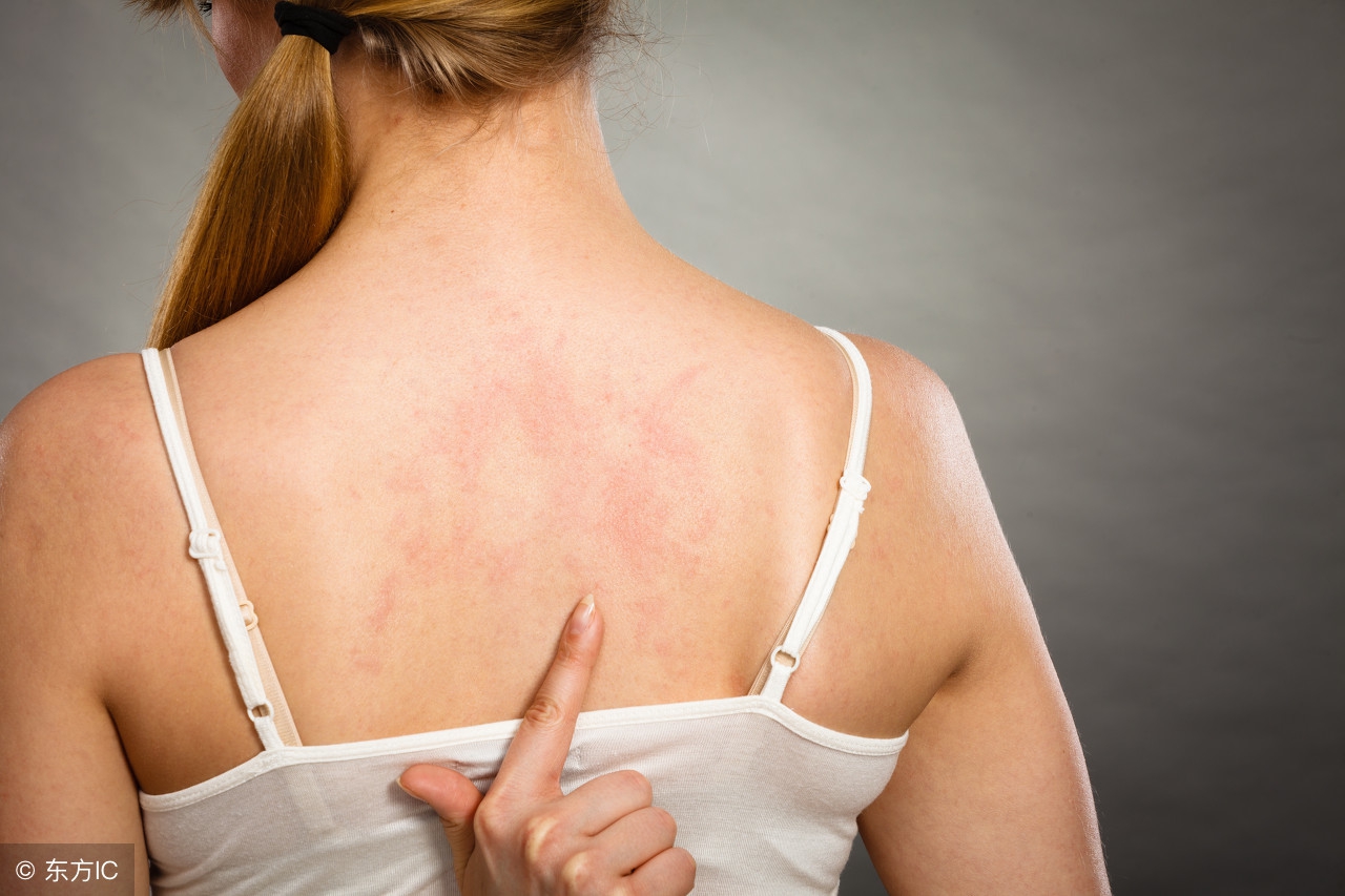 荨麻疹属于麻疹类型吗,得荨麻疹丘疹几天可以好