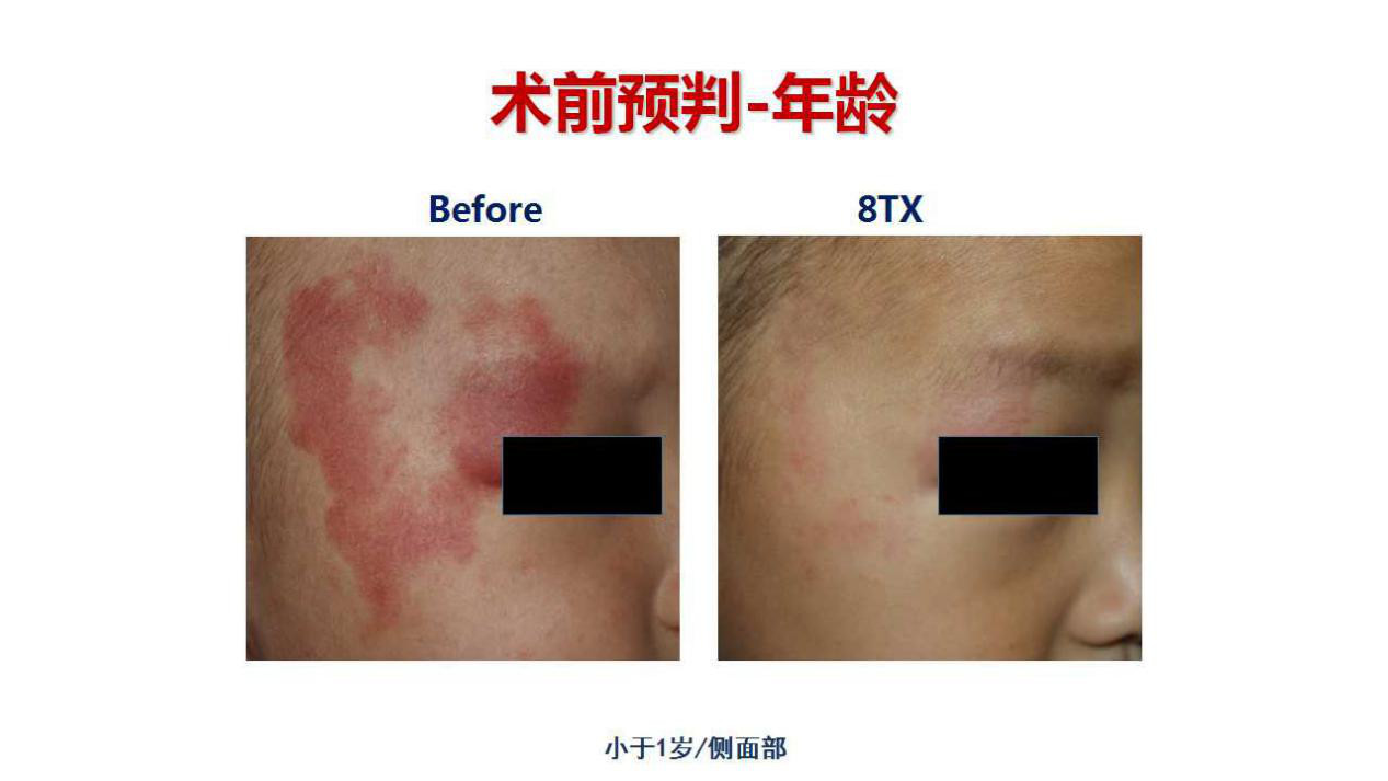 刚刚出生婴儿脸上长了肉痣怎么办,8个月宝宝脸上长雀斑样痣