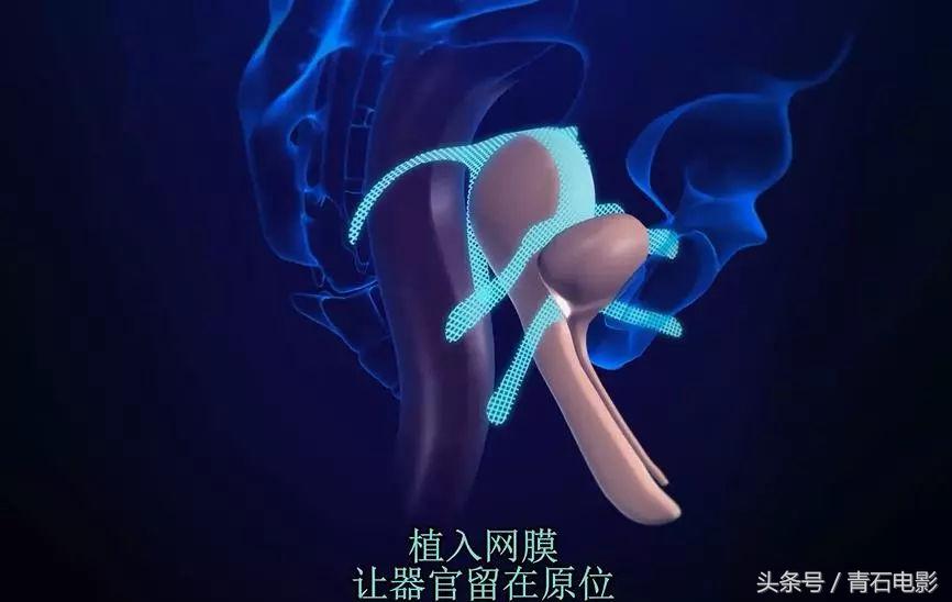 网飞出品的纪录片，上映后让美公司停售一款尖端医疗器械！