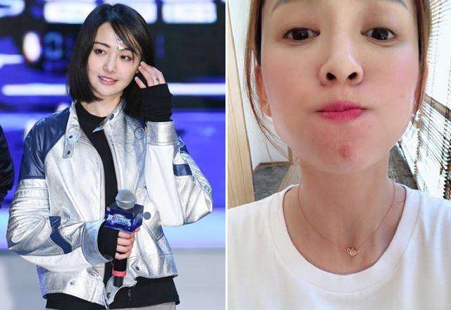 下巴最近反复长痘痘是什么原因,下巴频繁长痘痘是什么原因