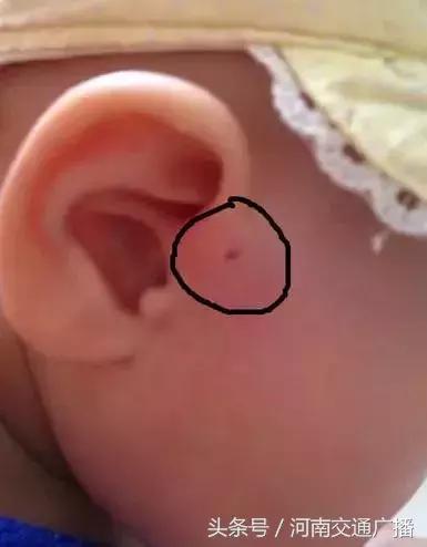 宝宝耳朵长出聪明孔,婴儿耳朵边长了小肉球