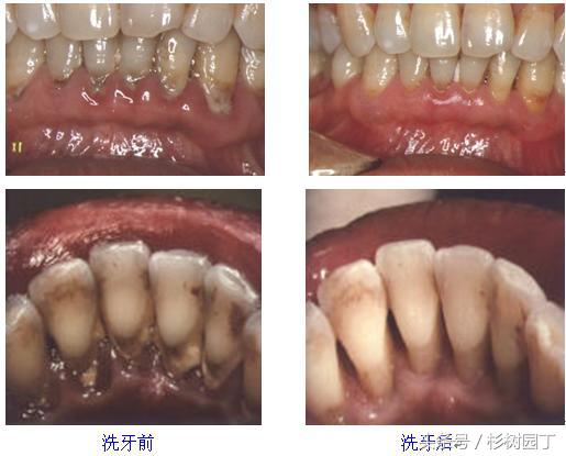 美牙仪真的有用吗骗人的吗,美牙仪是有线的好还是无线的好