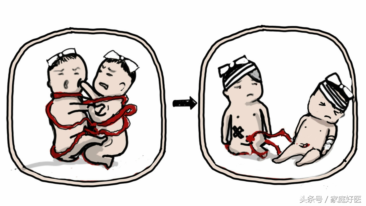 怀双胞胎一个会被另一个吸收吗,双胞胎吃掉另一个胎儿