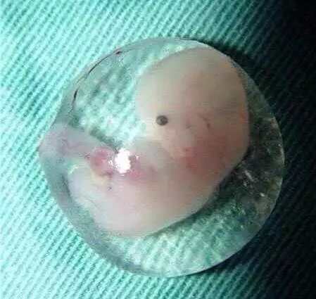 女孩宫外孕不敢面对父母结果悲剧,19岁女孩意外宫外孕