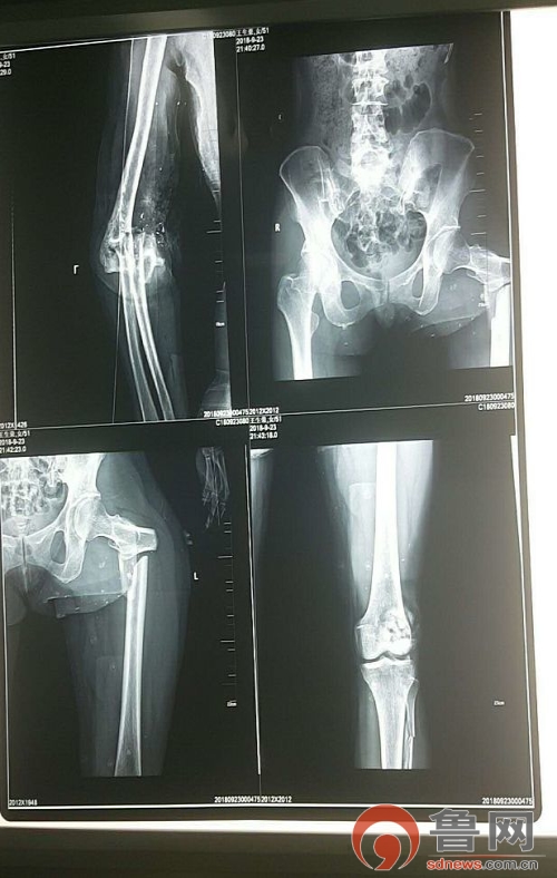 多学科协作成功救治一名危重患者,多科室联合抢救外伤患者