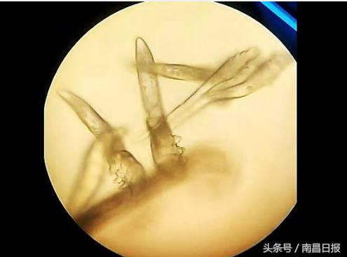 女生眼睫毛老是掉是什么原因,12岁女孩儿睫毛总是掉为什么