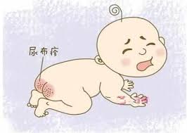 宝宝红屁股尿布疹反反复复 (宝宝尿布疹红屁股怎么预防)