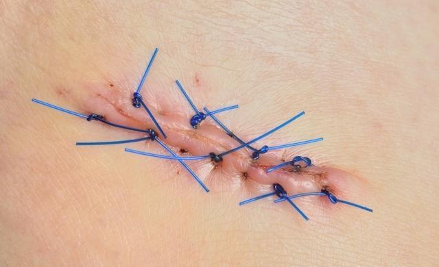 手术后切口是怎么愈合的,手术切口愈合分为哪三期